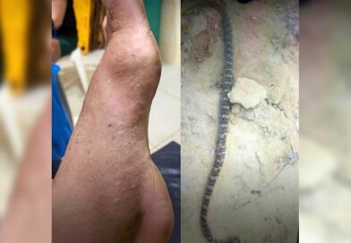 Agricultor picado por jararaca em Carnaubal é transferido para Sobral